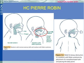 11
HC PIERRE ROBIN
NGUYÊN NHÂN SHH
 