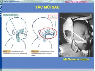 12
TẮC MŨI SAU
NGUYÊN NHÂN SHH
McGovern nipple
 