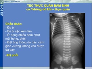 13
Chẩn đoán:
- Đa ối.
- Bú bị sặc kèm tím.
- Ứ đọng nhiều đàm nhớt
mũi họng, phổi.
- Đặt ống thông dạ dày: cảm
giác vướng không vào được
dạ dày.
-XQ phổi
TEO THỰC QUẢN BẨM SINH
có / không dò khí – thực quản
 
