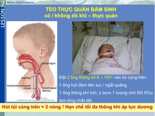 14
Hút túi cùng trên = 2 nòng ! Hạn chế tối đa thông khí áp lực dương
TEO THỰC QUẢN BẨM SINH
có / không dò khí – thực quản
Đặt 2 ống thông số 8 – 10Fr vào túi cùng trên:
1 ống hút đàm liên tục / ngắt quãng.
1 ống thông khí trời, ± bơm 1 lượng nhỏ NS 9%o
làm lỏng chất tiết.
 