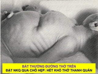 15
BẤT THƯỜNG ĐƯỜNG THỞ TRÊN
ĐẶT NKQ QUA CHỖ HẸP: HẾT KHÓ THỞ THANH QUẢN
 