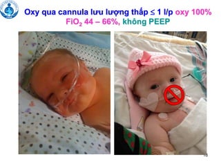 18
Oxy qua cannula lưu lượng thấp  1 l/p oxy 100%
FiO2 44 – 66%, không PEEP
 