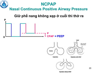 20
NCPAP
Nasal Continuous Positive Airway Pressure
P
P
CPAP
0
Giữ phế nang không xẹp ở cuối thì thở ra
= PEEP
 