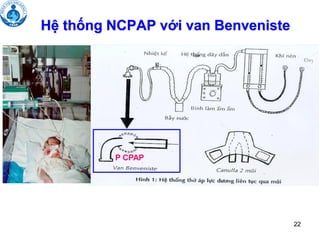 22
Hệ thống NCPAP với van Benveniste
P CPAP
22
 