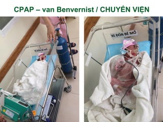 CPAP – van Benvernist / CHUYỂN VIỆN
23
 