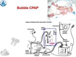 24
Bubble CPAP
P
CPAP
24
 