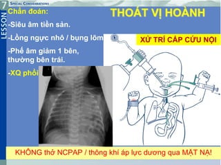 34
THOÁT VỊ HOÀNH
KHÔNG thở NCPAP / thông khí áp lực dương qua MẶT NẠ!
Chẩn đoán:
-Siêu âm tiền sản.
-Lồng ngực nhô / bụng lõm
-Phế âm giảm 1 bên,
thường bên trái.
-XQ phổi
XỬ TRÍ CẤP CỨU NỘI
 