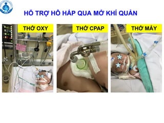 HỖ TRỢ HÔ HẤP QUA MỞ KHÍ QUẢN
THỞ OXY THỞ CPAP THỞ MÁY
 