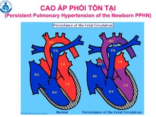 CAO ÁP PHỔI TỒN TẠI
(Persistent Pulmonary Hypertension of the Newborn PPHN)
 