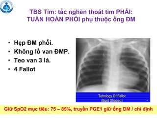 TBS Tím: tắc nghẽn thoát tim PHẢI:
TUẦN HOÀN PHỔI phụ thuộc ống ĐM
• Hẹp ĐM phổi.
• Không lổ van ĐMP.
• Teo van 3 lá.
• 4 Fallot
Giữ SpO2 mục tiêu: 75 – 85%, truyền PGE1 giữ ống ĐM / chỉ định
 