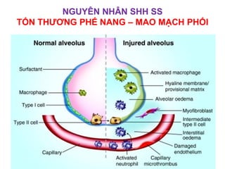 NGUYÊN NHÂN SHH SS
TỔN THƯƠNG PHẾ NANG – MAO MẠCH PHỔI
 