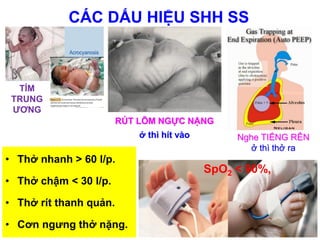CÁC DẤU HIỆU SHH SS
TÍM
TRUNG
ƯƠNG
• Thở nhanh > 60 l/p.
• Thở chậm < 30 l/p.
• Thở rít thanh quản.
• Cơn ngưng thở nặng.
Nghe TIẾNG RÊN
ở thì thở ra
RÚT LÕM NGỰC NẶNG
ở thì hít vào
SpO2 < 90%,
 