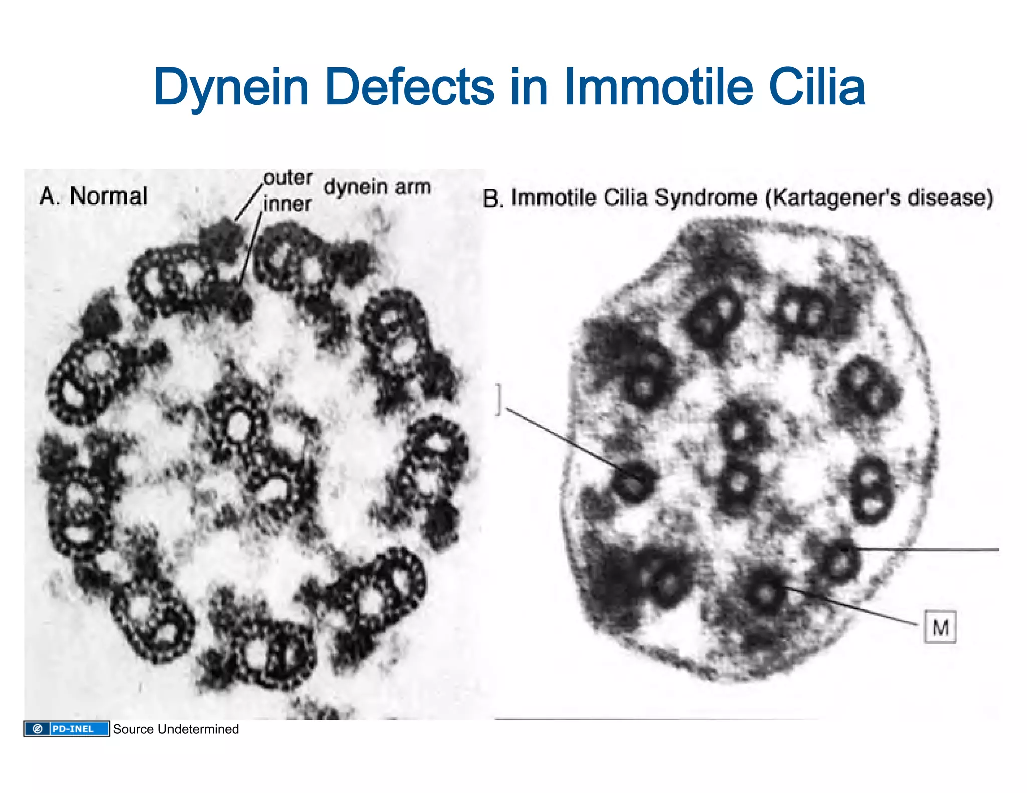 Dynein Defects in Immotile Cilia 




Source Undetermined
 