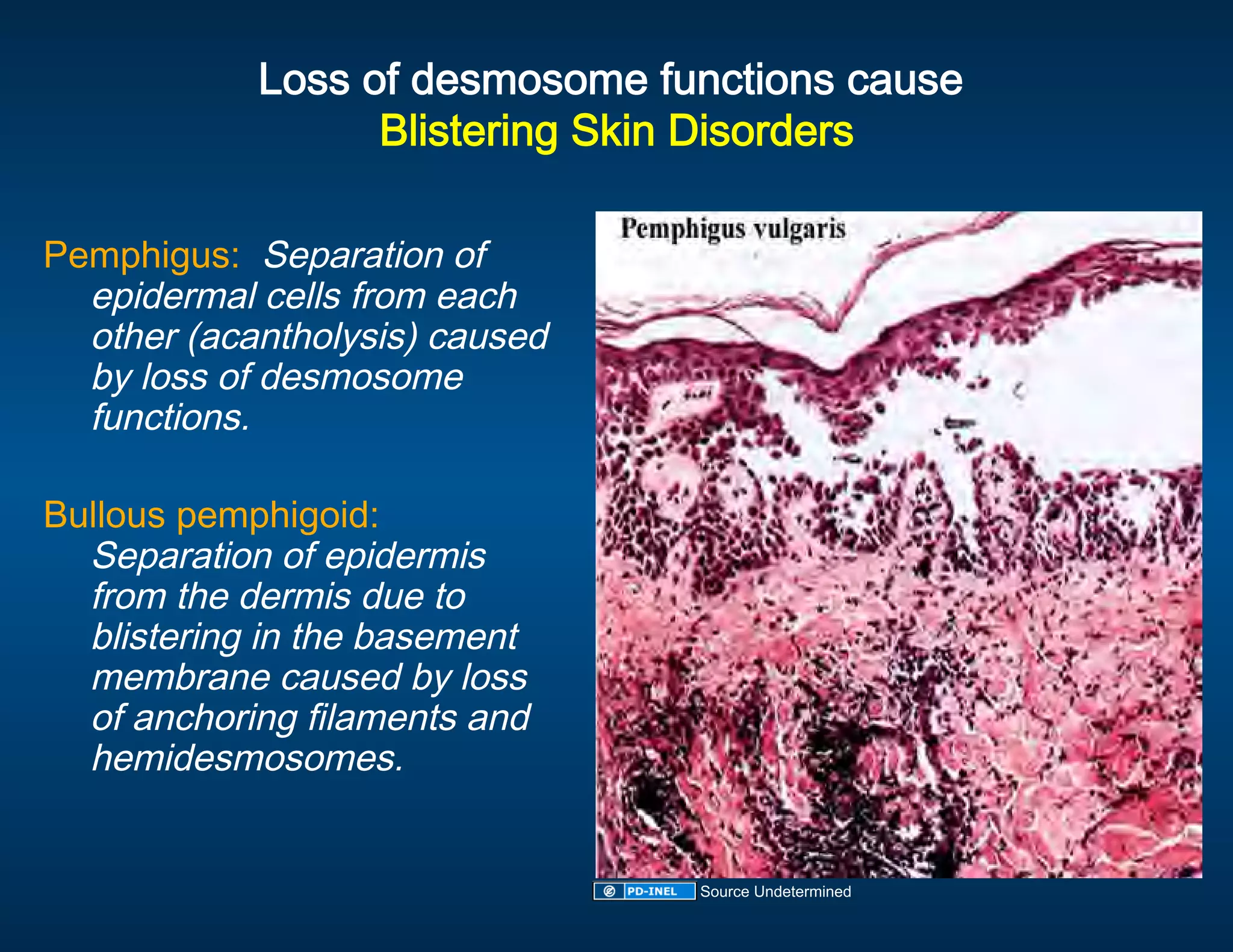 Loss of desmosome functions cause 
                                              
                  Blistering Skin Disorders
                                           
 
Pemphigus:  Separation of 
  epidermal cells from each 
  other (acantholysis) caused 
  by loss of desmosome 
  functions. 
 
Bullous pemphigoid:  
  Separation of epidermis 
  from the dermis due to 
  blistering in the basement 
  membrane caused by loss 
  of anchoring filaments and 
  hemidesmosomes. 
 

                                 Source Undetermined
 