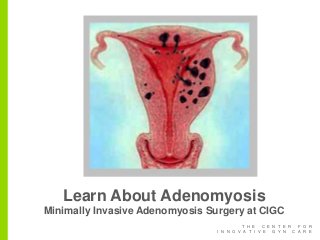 T H E C E N T E R F O R
I N N O V A T I V E G Y N C A R E
Learn About Adenomyosis
Minimally Invasive Adenomyosis Surgery at CIGC
 
