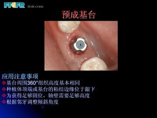 预成基台




应用注意事项
v 基台周围360°组织高度基本相同
v 种植体顶端或基台的粘结边缘位于龈下
v 为获得足够固位，轴壁需要足够高度
v 根据邻牙调整倾斜角度
 