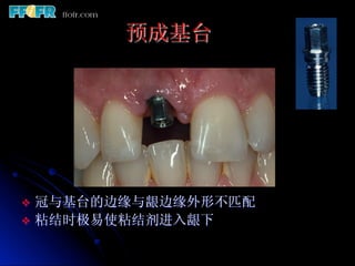 预成基台




v  冠与基台的边缘与龈边缘外形不匹配
v  粘结时极易使粘结剂进入龈下
 