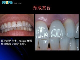 预成基台




戴牙后两年半，可以观察到
种植体周牙龈的炎症。	
 