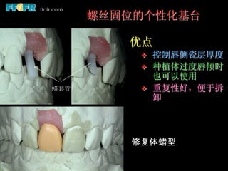 螺丝固位的个性化基台

         优点
          v    控制唇侧瓷层厚度
          v    种植体过度唇倾时
                也可以使用
蜡套管       v    重复性好，便于拆
                卸




         修复体蜡型	
 