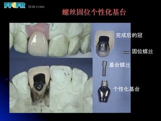 螺丝固位个性化基台


       完成后的冠	


            固位螺丝	

      基台螺丝	



       个性化基台	
 