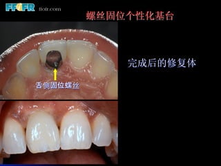 螺丝固位个性化基台



               完成后的修复体

舌侧固位螺丝	
 
