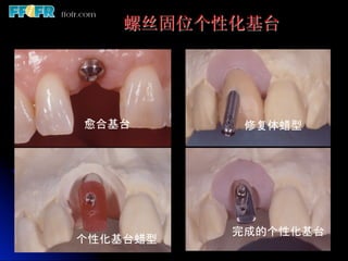 螺丝固位个性化基台




愈合基台	
       修复体蜡型	




            完成的个性化基台	
个性化基台蜡型	
 