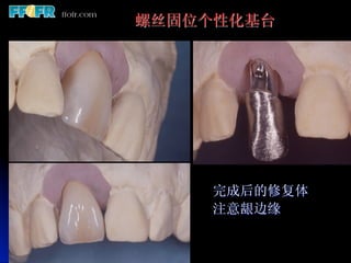 螺丝固位个性化基台




    完成后的修复体
    注意龈边缘
 