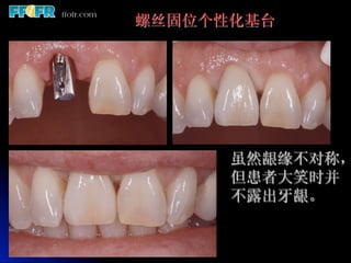 螺丝固位个性化基台




     虽然龈缘不对称，
      但患者大笑时并
      不露出牙龈。
 