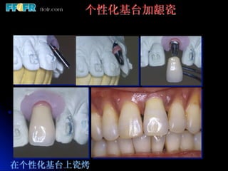 个性化基台加龈瓷




在个性化基台上瓷烤
 