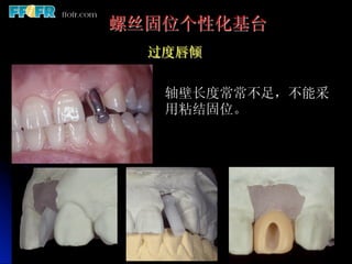 螺丝固位个性化基台
  过度唇倾


   轴壁长度常常不足，不能采
   用粘结固位。
 