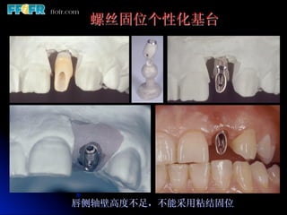 螺丝固位个性化基台




唇侧轴壁高度不足，不能采用粘结固位
 