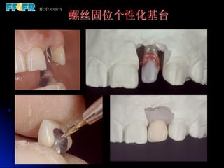 螺丝固位个性化基台
 