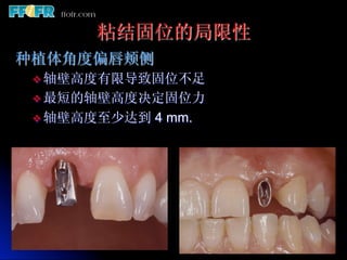 粘结固位的局限性
种植体角度偏唇颊侧
 v  轴壁高度有限导致固位不足
 v  最短的轴壁高度决定固位力
 v  轴壁高度至少达到   4 mm.
 