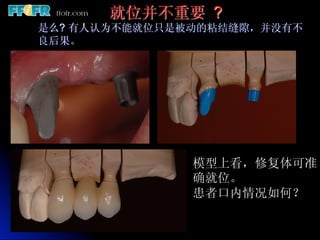 就位并不重要 ?
是么? 有人认为不能就位只是被动的粘结缝隙，并没有不
良后果。




               模型上看，修复体可准
               确就位。
               患者口内情况如何？
 