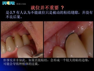 就位并不重要 ?
是么? 有人认为不能就位只是被动的粘结缝隙，并没有
不良后果。




但事实并非如此。如果直接粘结，会形成一个较大的粘结边缘，
可能会导致种植体的过载。
 