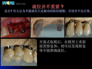       就位并不重要   ?
是么? 有人认为不能就位只是被动的粘结缝隙，并没有不良后果。




            开窗式取模后，在模型上重新
            放置修复体，则可以发现修复
            体不能准确就位。
 