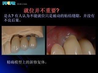    就位并不重要?
是么? 有人认为不能就位只是被动的粘结缝隙，并没有
不良后果。




精确模型上的新修复体。
 