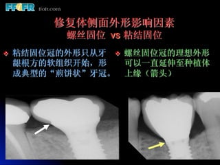 修复体侧面外形影响因素
             螺丝固位 vs 粘结固位
v    粘结固位冠的外形只从牙 v  螺丝固位冠的理想外形
      龈根方的软组织开始，形     可以一直延伸至种植体
      成典型的“煎饼状”牙冠。 上缘（箭头）
 