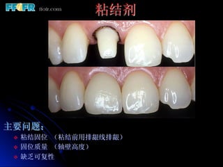 粘结剂




主要问题：
 v  粘结固位 （粘结前用排龈线排龈）
 v  固位质量 （轴壁高度）
 v  缺乏可复性
 