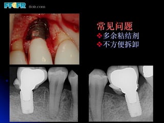 常见问题
v 多余粘结剂
v 不方便拆卸
 
