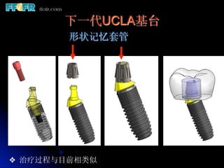 下一代UCLA基台
        形状记忆套管




❖  治疗过程与目前相类似
 