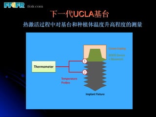 下一代UCLA基台
热激活过程中对基台和种植体温度升高程度的测量
 