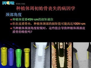种植体周初始骨丧失的病因学
颈部角度
 v 种植体需要45N·cm的扭矩就位
 v 但在皮质骨内，种植体颈部的扭矩值可能高达100N·cm
 v 当种植体颈部角度较锐时，这些值会导致种植体颈部皮
 质骨的吸收吗？
 