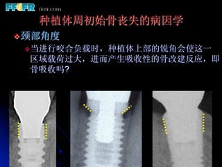 种植体周初始骨丧失的病因学
v 颈部角度
 v 当进行咬合负载时，种植体上部的锐角会使这一
  区域载荷过大，进而产生吸收性的骨改建反应，即
  骨吸收吗?
 