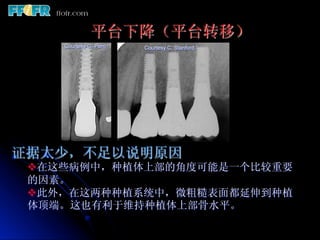 平台下降（平台转移）
    Courtesy G. Perri   Courtesy C. Stanford




证据太少，不足以说明原因
 v 在这些病例中，种植体上部的角度可能是一个比较重要
 的因素。
 v 此外，在这两种种植系统中，微粗糙表面都延伸到种植
 体顶端。这也有利于维持种植体上部骨水平。
 