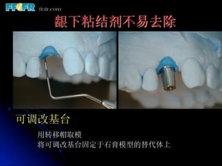 龈下粘结剂不易去除




可调改基台
  用转移帽取模
 将可调改基台固定于石膏模型的替代体上
 
