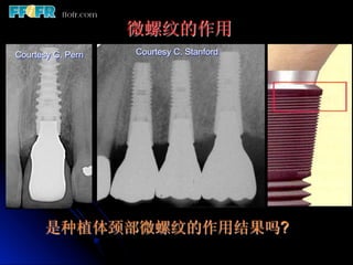 微螺纹的作用
Courtesy G. Perri   Courtesy C. Stanford




       是种植体颈部微螺纹的作用结果吗?
 