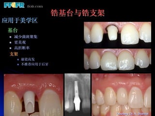 锆基台与锆支架
应用于美学区
基台
 l    减少菌斑聚集
 l    更美观
 l    高折断率
 支架
       l    崩瓷高发
       l    不推荐应用于后牙




                                  Courtesy Dr. A. Sharma
 