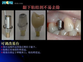 龈下粘结剂不易去除




可调改基台
v 基台边缘经过预备后稍位于龈下。
v 取模后常规制作烤瓷冠。
v 将基台固定于种植体上，粘结烤瓷冠。
 
