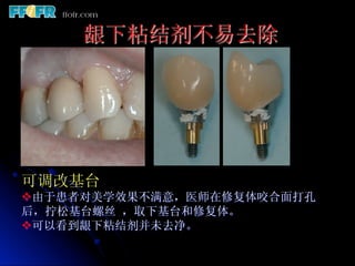 龈下粘结剂不易去除




可调改基台
v 由于患者对美学效果不满意，医师在修复体咬合面打孔
后，拧松基台螺丝 ，取下基台和修复体。
v 可以看到龈下粘结剂并未去净。
 
